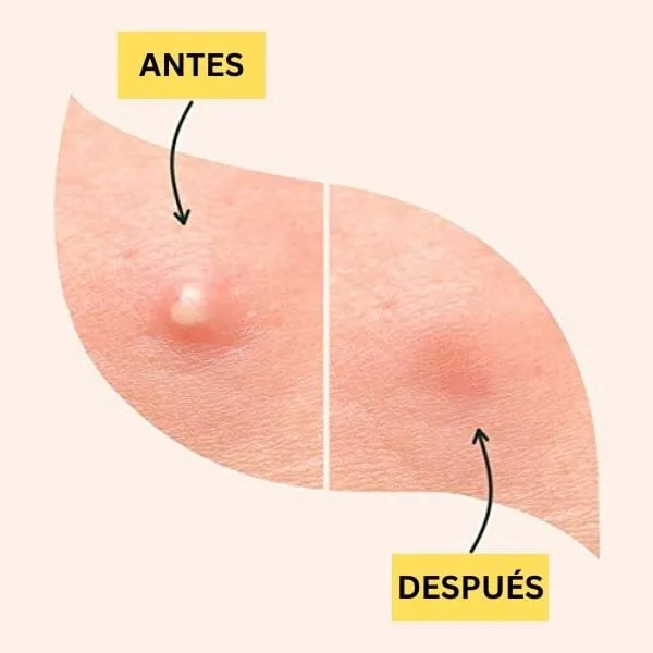 Stickers para acne mis cosmétics - Image 4